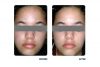 DUSA Acne Light Treatment Before & After 2