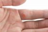 Destruction of Benign Lesion