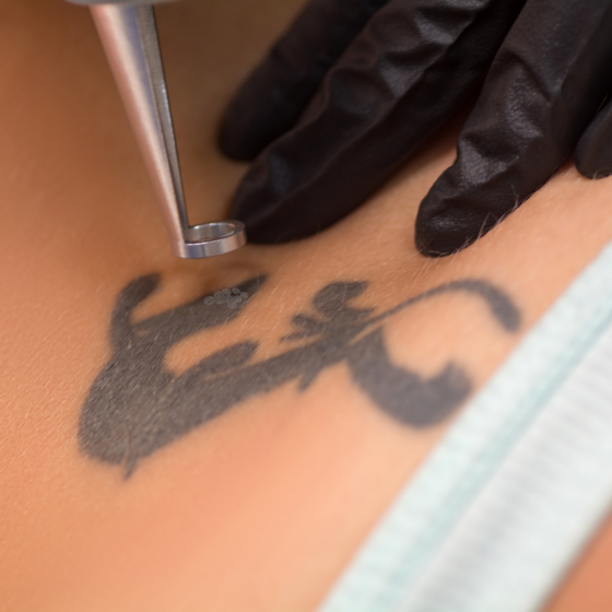 Laser tattoo Removal Consultation