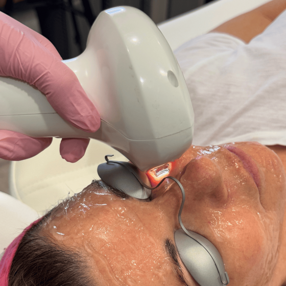 IPL Photofacial
