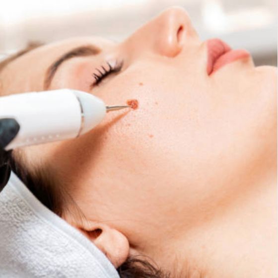 Mole Removal