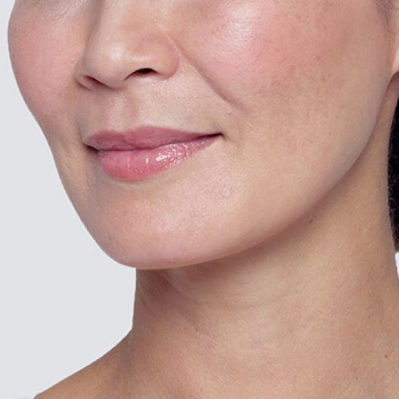 Restylane® Lyft