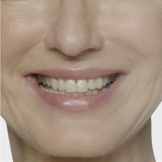Restylane® Refyne