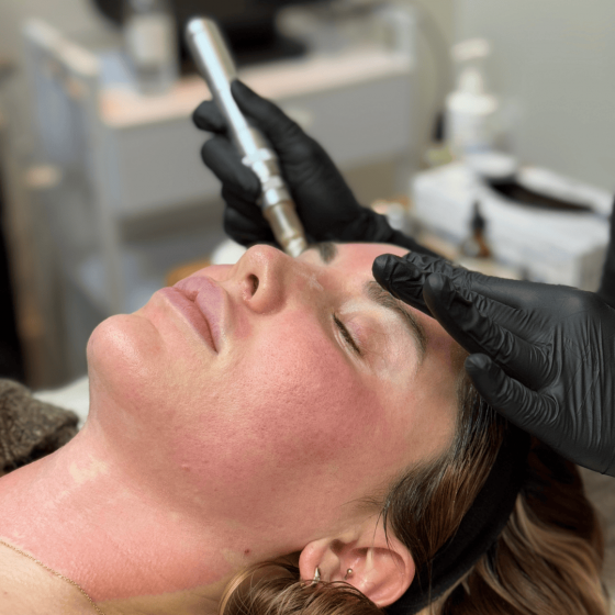 Microneedling - SkinStylus®