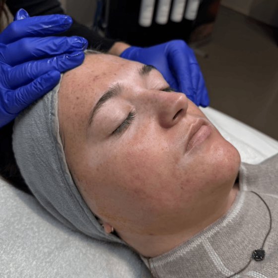 VI Peel PURIFY with Precision Plus