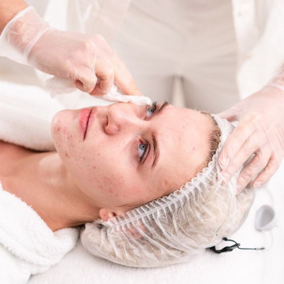 Acne Facial