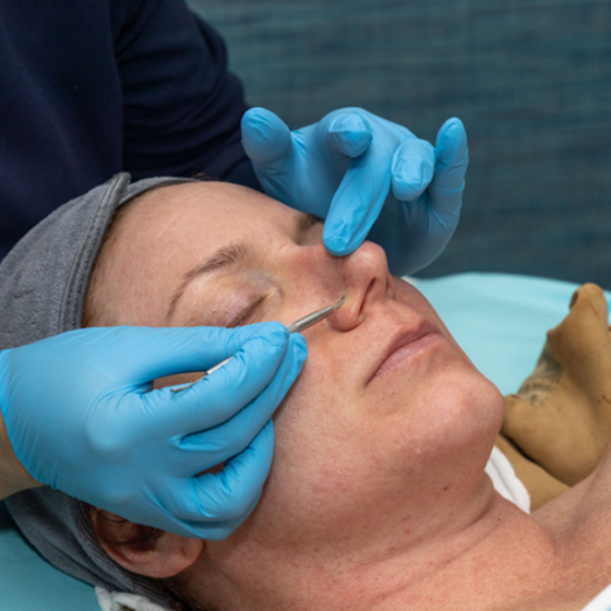 Acne Resolution Treatment