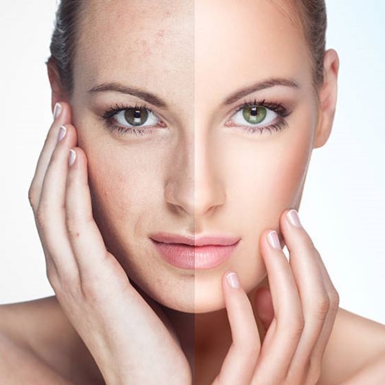 Acne Extractions