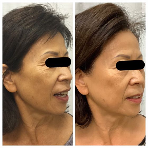 anteage_microneedling_66166