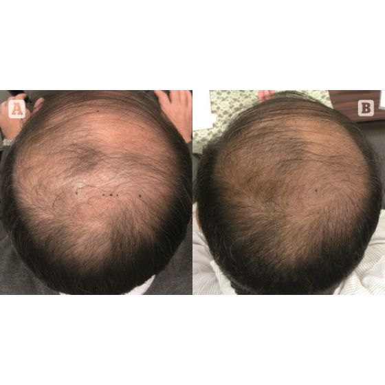 ProGen PRP™ Platelet Rich Plasma Hair Restoration