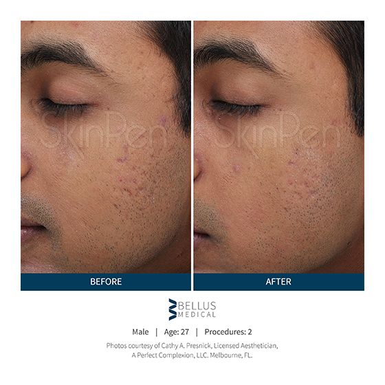 SkinPen Before & After