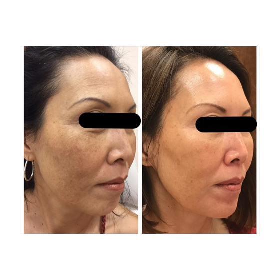 chemical-peel_chemical-peel_66320