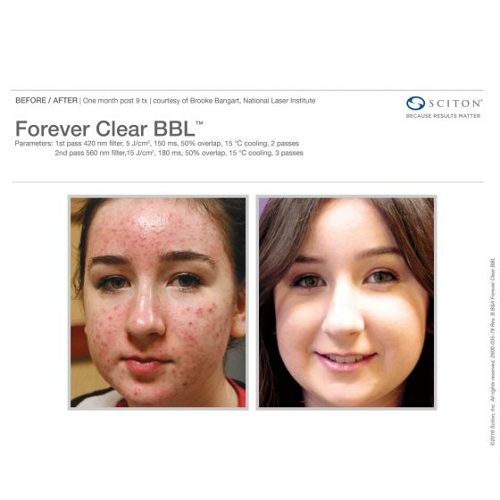 Forever Clear BBL™