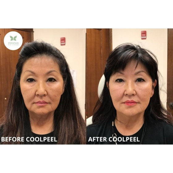 coolpeel_coolpeel_66128