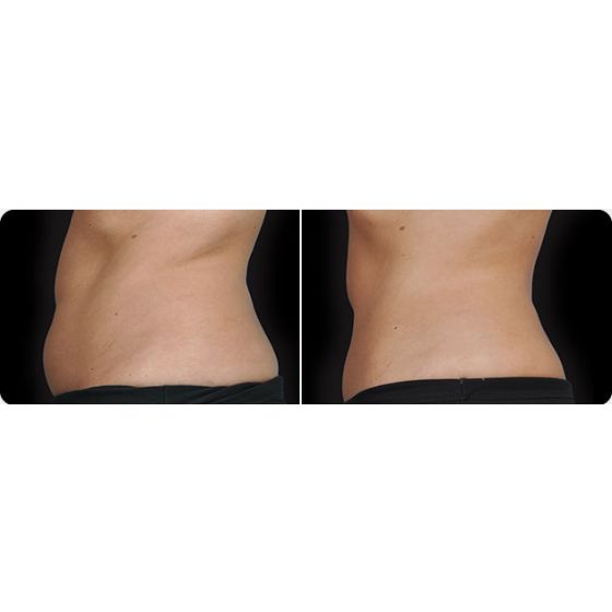 CoolSculpting Before and After 4