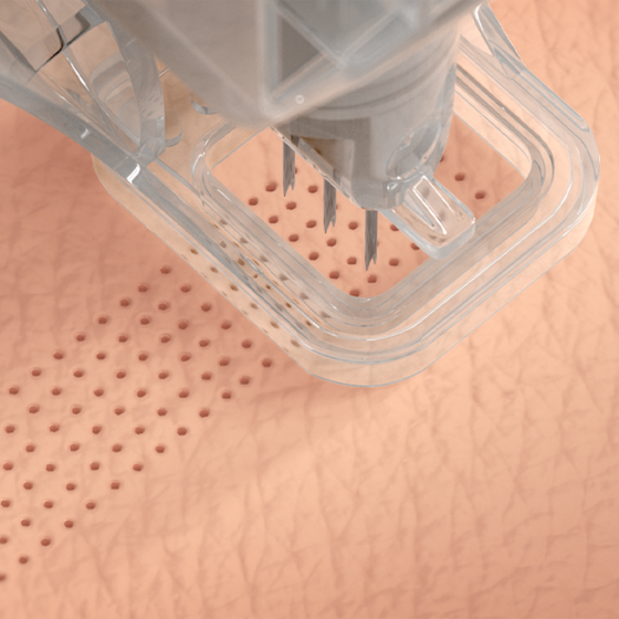 Ellacor® System with Micro-Coring™ Technology