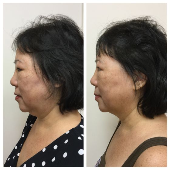 kybella_kybella_66153