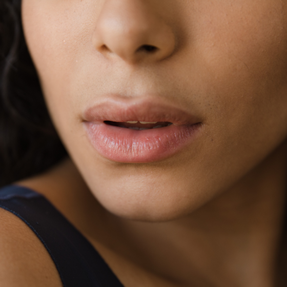 JUVÉDERM® Ultra XC