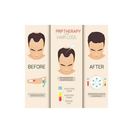 prp-hair-loss-new