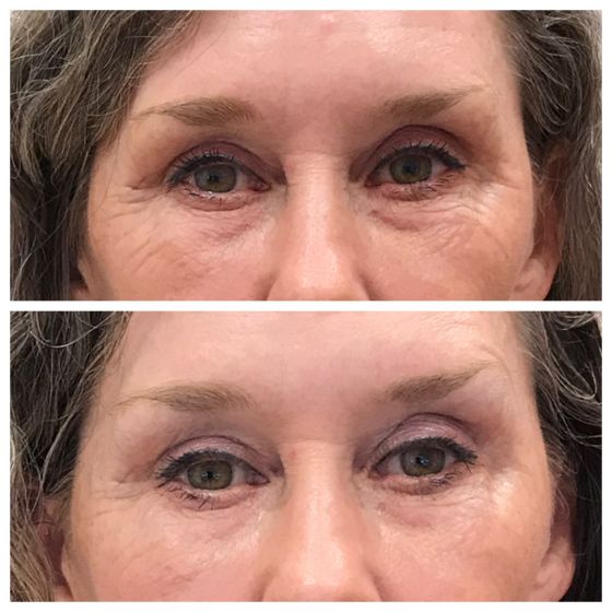 prp_microneedling_66170