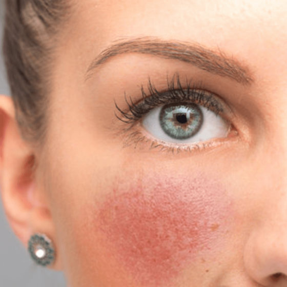 Rosacea Peel