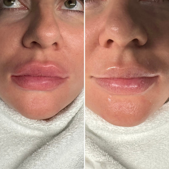 Snow Lips Treatment