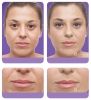Juvederm - Jennifer