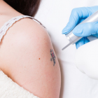 Laser Tattoo Removal Consultation