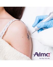 Laser Tattoo Removal