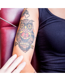 Laser Tattoo Removal