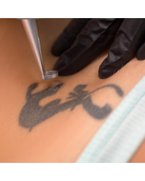 Laser tattoo Removal Consultation