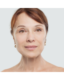 Ultherapy