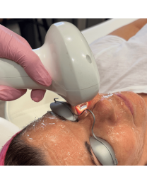 IPL Photofacial