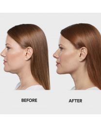 Kybella