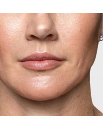 Restylane® Contour