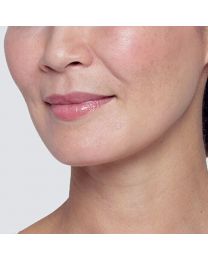 Restylane® Lyft