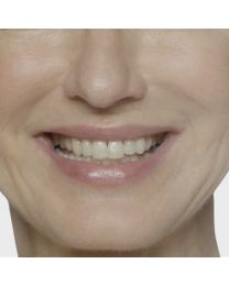 Restylane® Refyne