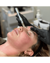 Microneedling - SkinStylus®
