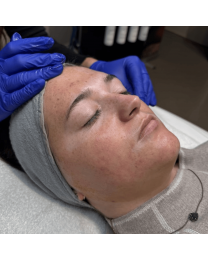 VI Peel PURIFY with Precision Plus