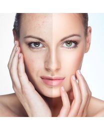 Acne Extractions