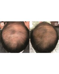 ProGen PRP™ Platelet Rich Plasma Hair Restoration