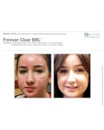 Forever Clear BBL™