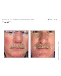ClearV®