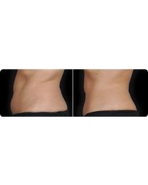 CoolSculpting Before and After 4