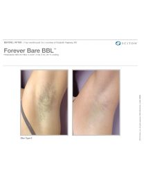 Forever Bare BBL