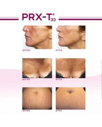 PRX Derm Perfexion
