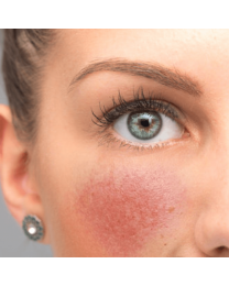 Rosacea Peel