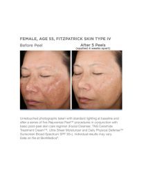 Rejuvenize Peel™