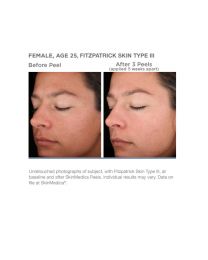 Rejuvenize Peel™