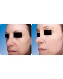 SkinPen before and after